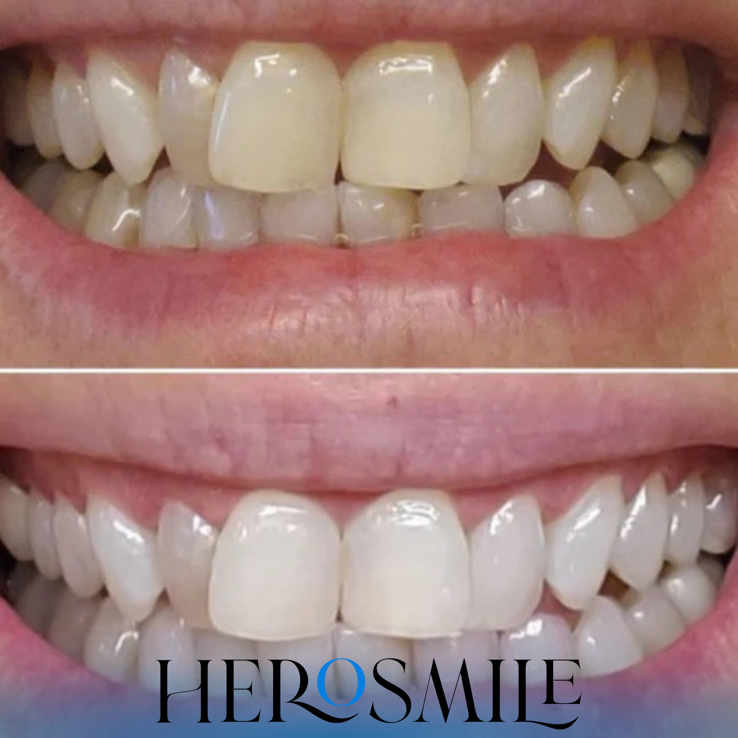 Ultra whitening set