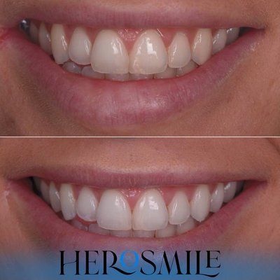 Correction des couleurs - Comprimés de dentifrice
