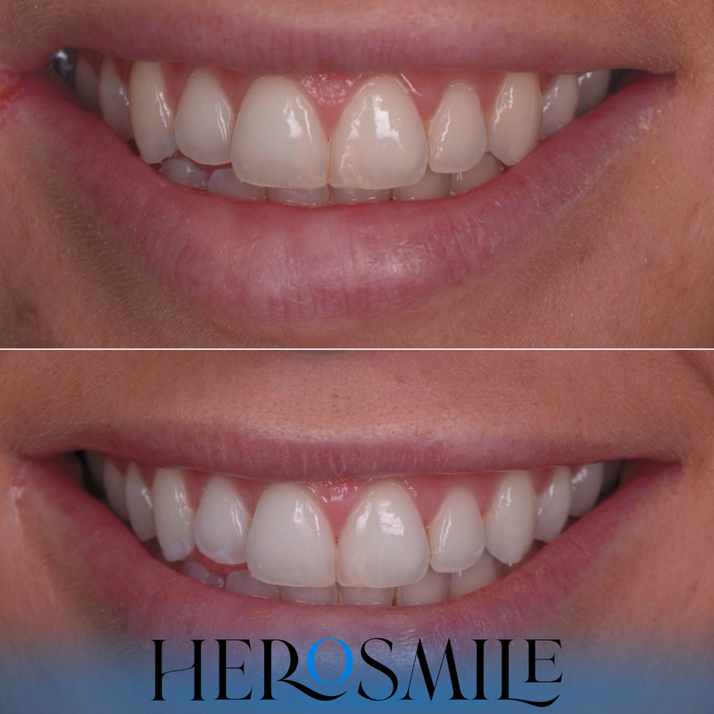 Correction des couleurs - Comprimés de dentifrice
