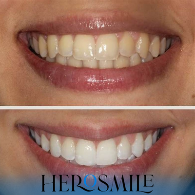 Bandes de blanchiment des dents